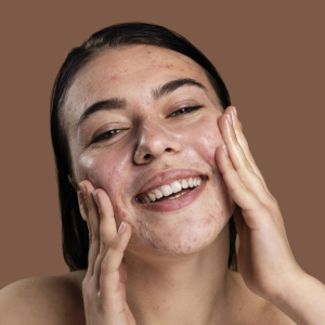 Tratamiento de Secuela de Acné